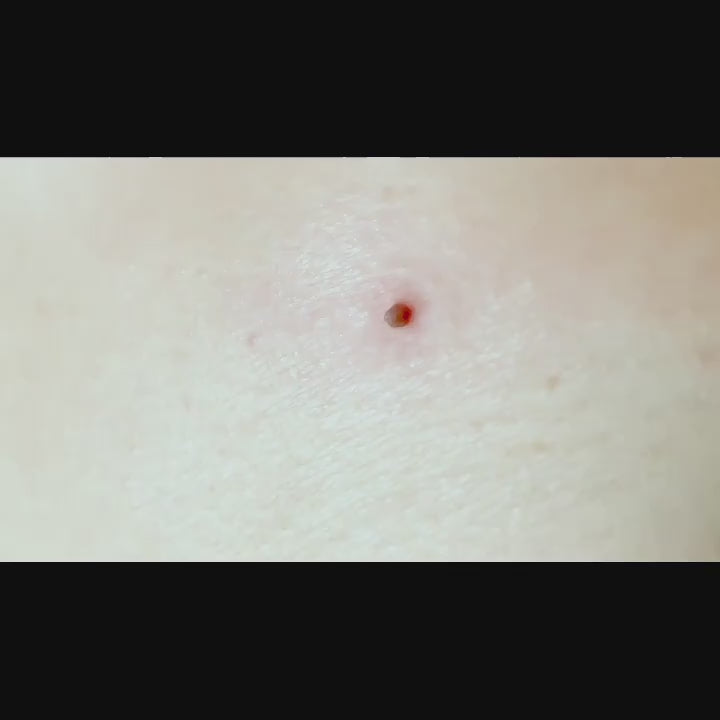 Auto Skin Tag Removal Tool Kit 3 in 1 Skin Tag Remover Device 1mm to 8mm Auto Wart Remover Safe  Painless  Easy Remover Clear Skin Tag  Mole at Home